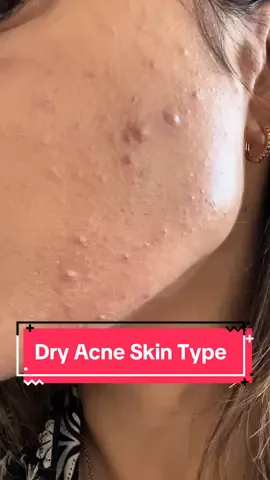 Draft from last winter. Acne is usually associated with oily skin types, but for me I am a dry skin type and acne prone girly. Especially in the winter when the air is cold and dry. Its impossible to cover the acne up without it going crusty and dusty.  #dryskin #acneproneskin #acneskin #acnefighter #dryskintype #acnemakeup #foundationhack #acnefighter 