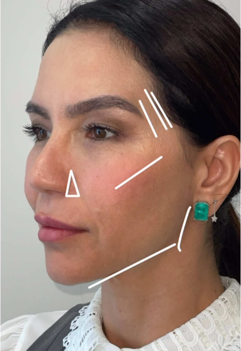 Te deixo + bela e elegante com harmonização facial 🧚🏻 O caso acima não representa em hipótese alguma garantia de resultado. Visto que cada paciente possui características fisiológicas e anatômicas únicas. Dra. Kelly Brasileiro, cirurgião-dentista, especialista em Harmonização Orofacial (HOF) e Membro da Associação Paulista de cirurgiões dentistas (APCD). Gostou do conteúdo? Salve para lembrar quando quiser! Para agendamentos link na Bio. ✨ Dra Kelly Brasileiro CROSP 124338 #preenchimentolabialsp #moemasp #cuidadoscomapele #ibirapuera #harmonizacaofacial #preenchimentofacial #fullface