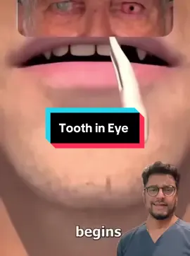 Toith in Eye Surgery is real 