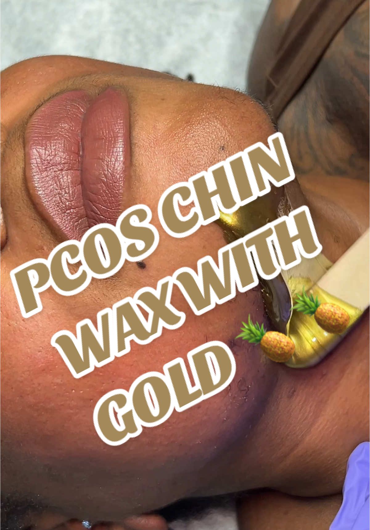 PCOS/HIRSUTISM FACE WAX!  Using Gold 🍍by @wakse™ (link in bio for webiste and discount code)  #fyp #pcos #wax #foryou #pineapple #gold #viral 