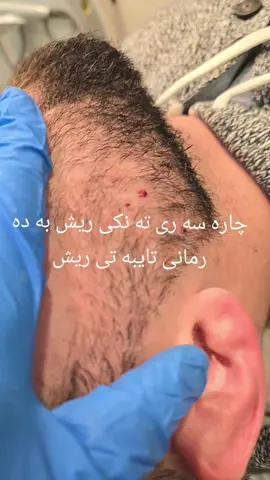 #London #Birmingham #mesotherapy #foryoupage #uk #istanbul ##baretanya #به ریتانیا