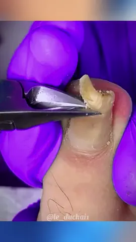 How to remove nail craving nail  #ingrowntoenailremovalprocedure #ingrowntoenail #infectedtoenail 
