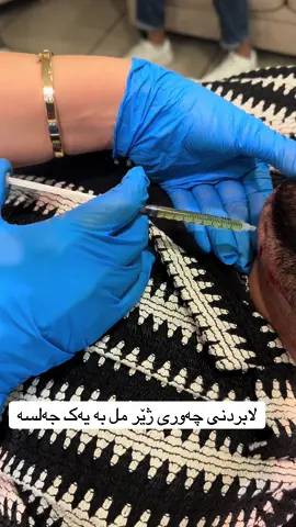 لابردنی چەوری ژێرمل بە یەک جەلسە  بۆ پەیوەندی  07377761494 #aesthetic #hifu #treatment #filler #botox #hairtreatment #fatdissolving #hydrofacial #hairlaserremoval 