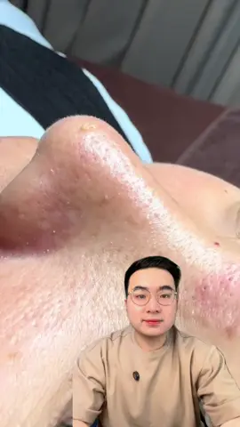 Komedo boleh kok di facial, tapi yang penting cegah juga dengan serum2 ini ya #skincare #retinol #komedo #blackhead #fypシ゚viral 