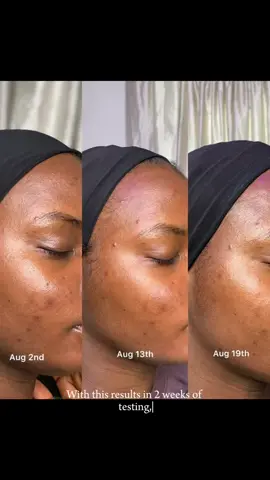 The results speak fir themselves! Tested on wonen of color across Africa  🧡  #glowinyourconfidence #darkspotserum #hyperpigmentation #licoricerootdarkspotserum #hyperpigmentationtreatment #uncoverskincare #fypシ゚viral