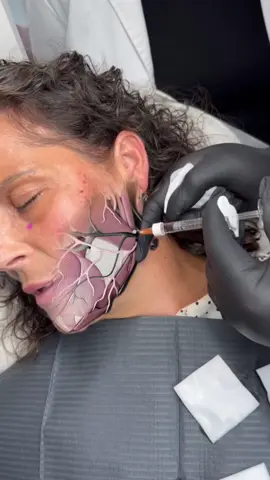 Do you practice a 3D Anatomy Vision?🩶✔️ Being able to assess and visualize the layers beneath the skin—muscle, fat, and bone—is crucial to achieving safe and precise results 💉 This deeper insight into facial anatomy is key to delivering amazing results while minimizing risks 🩷 Want to expand your knowlegde on the 3D Anatomy? Send me a DM and we will book you in for the Facial Anatomy Masterclass 🫶🏼 #dermalfillers #facialfillers #jawline #jaw #jawfiller #fillers #aesthetics #profilebalancing #facialharmonization