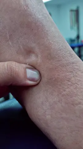 signo de godet :)  El edema es líquido que se acumula bajo la piel, dentro de los tejidos que están fuera del sistema circulatorio. Ente las causas se encuentran:  -Inmovilidad o inactividad -Tras eventos traumáticos y por alteraciones vasculares -Problemas de riñones, higado o corazón. -Algunos tipos de quimioterapia o cáncer. -Medicamentos Se debe conocer la causa que lo provoca, pues el edema NO ES UN ENFERMEDAD sino manifestación de otros problemas. En fisioterapia se puede ayudar a su manejo y reducción con Drenaje Linfático Manual, Movilizaciones, Hidroterapia, además de modificar hábitos como la actividad física, consumo de sal y agua.