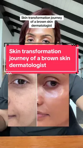 Skin care transformation of a 37 y/o brown skin dermatologist #skintransformation #skincarejouney #skincare #browntiktok #browngirl #brownskin #skincaretips #dermatologist #orangecounty #newport #orangecountydermatologist 