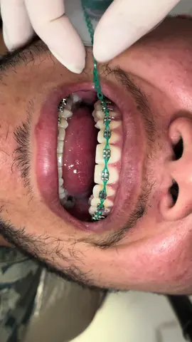 Dica de cor que não desbota: verde Pérola  #ortodoncia #ortodontia #braces #bracestips #orthodontics #bracketsmetalicos #aparelhoortodontico #aparelhofixo #brackets #bracescolors #verde 