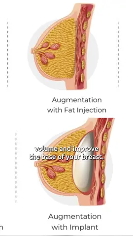 Lipo filling or breast augmentation? This is a great question! Transfering fat to the breasts helps with the contour and cleavage but only a breast implants helps adding volume. Sometimes it is a great option to use both! But this will depend of your case. Always feel free to reach out to us to five you the best advice and surgical plan! #tijuanaplasticsurgery #dranajar #plasticsurgerytijuana #tijuanasurgery #lipofilling #fattransferrobreasts #fattransfertocleavage #lipofilling #breastfatransfer 