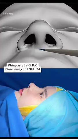 Rhinplasty 1999 RM, Nose wing cut 1200 RM #drwonyang #fly #rhinoplasty #nosewing #comesticsurgery #kualalumpur #kualalumpurmalaysia #tiktokmalaysia #malaysia 