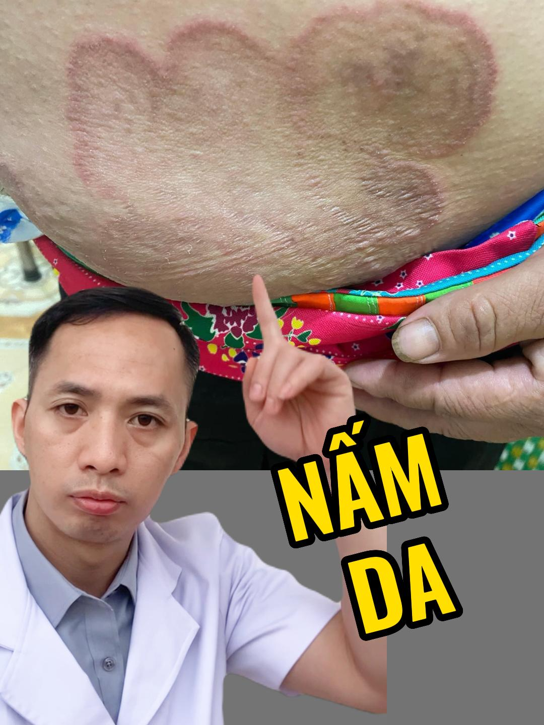 Nấm da:   Tổn thương cơ bản (TTCB) của Nấm da: là đám da sẫm màu hoặc viêm đỏ, ranh giới rõ, hình tròn hoặc bầu dục hoặc hình nhiều vòng cung, cao hơn mặt da lành, xung quanh có viền bờ rõ rệt, trên viền có mụn nước nhỏ, ở giữa có xu hướng lành; vị trí: ở các vùng da ẩm hơn: nách, bẹn, bung.... Ngứa nhiều khi ra mồ hôi và ra nắng. Chẩn đoán xác định bằng soi nấm. Điều trị bằng thuốc bôi, uống chống nấm. #nam #namda #dalieu #benhdalieu #dalieuthammy #xuhuong #nhacxuhuong #xuhuongtiktok