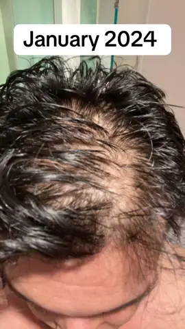 Hair loss isnt easy, follow my full journey on my TikTok page #hairloss #minoxidil #hairgrowth 