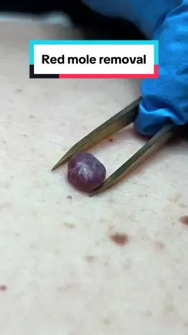 Today on our advanced blemish removal training course, we had the opportunity to treat a red mole (also known as a cherry angioma) for one of our clients, and it was incredibly satisfying to see it successfully removed! Cherry angiomas are small, benign growths made up of tiny blood vessels, usually appearing as red or purple spots on the skin. While harmless, many people choose to have them removed for cosmetic reasons. At Kolaine Beauty Lounge, we use electrolysis to treat these red moles effectively. This technique involves using a fine probe to target the blood vessels in the mole, causing it to shrink and eventually disappear. It’s a quick, safe, and minimally invasive method, with immediate results and little downtime. Our client was thrilled with the outcome, and it’s always rewarding to know we can help people feel more confident in their skin. If you’ve got a red mole or any other skin blemish you’d like to address, electrolysis could be the perfect solution! 📍 **Kolaine Beauty Lounge**   📞 **Contact us:** 01536 601379   🌐 **Visit us:** [www.kolainebeautylounge.com](http://www.kolainebeautylounge.com)   #Electrolysis #BlemishRemoval #CherryAngioma #RedMoleRemoval #SkinCare #BeautyLounge #ConfidenceBoost #NorthamptonBeauty #SkinHealth #ClientSatisfaction #KolaineBeautyLounge #5StarService #AdvancedAesthetics #mole #molereduction #moleremoval 