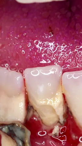 You wont believe the amazing before and after. See the full thing on my YouTube channel DrParker #dentalcalculus #cleanteeth #howtoclean #dentalhygienist 