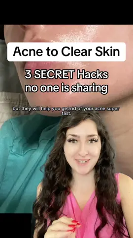 My 3 secrets for clear skin if you have acne - FREE Acne E-book available in bio #acne #acnetreatment #acneskin #acnefighter #clearskin 
