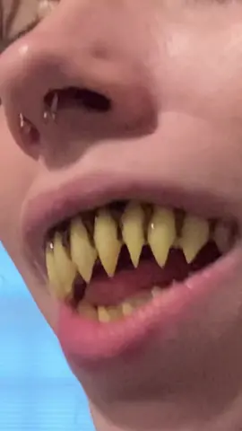 Why Is This FRIGHTENING Tooth Trend Is Taking Over!? 🧛🦷  #teeth #vampire #dentist 