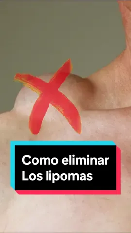 ¿Qué es son Los Lipomas? son bultos de grasa que se formar debajo de la piel Si te genera incómodad y pues eliminarlos #lipoma #tumor #bulto #piel #bola #grasa #estres #cirugia #parati #viraltiktok #fyp