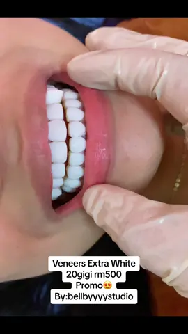 Veneers Extra putih✅ #Veneersgigi #ExtraWhite #bellbyyyystudio_real 