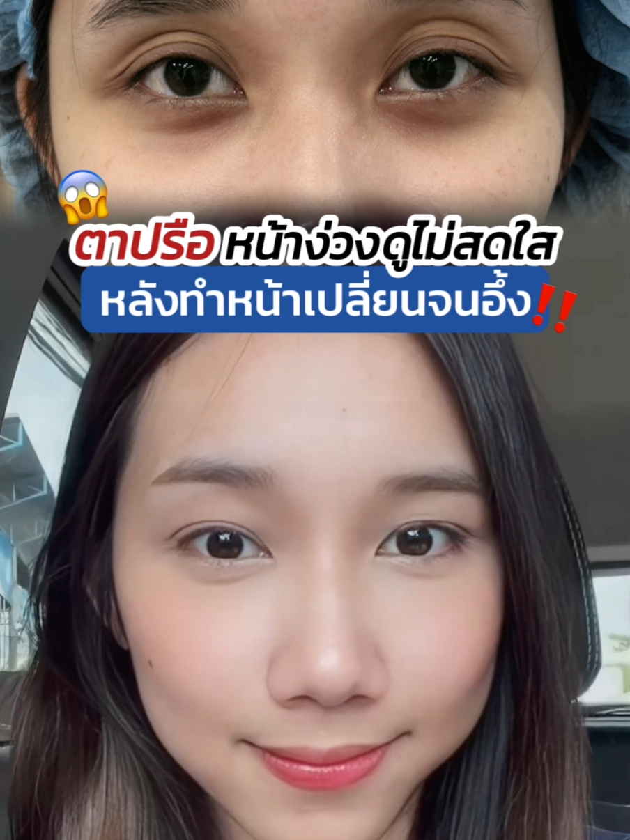 ตาลึก ตาปรือดูง่วง #ทำตาสองชั้น เปลี่ยนจนอึ้ง 😱 #หมอสกาย #skyclinic  #รีวิวตาสองชั้น #สกายคลินิก #รีวิวตาสองชั้นskyclinic #sweeteyes #ทําตาที่ไหนดี #รีวิวศัลยกรรม #รีวิวบิวตี้ 