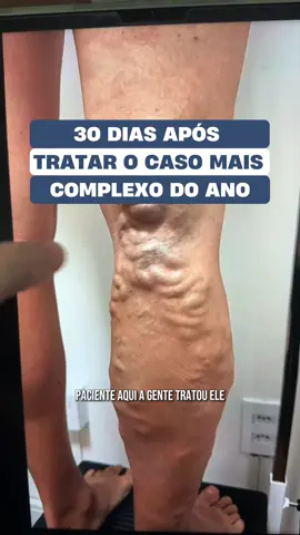 Olha só esse resultado 🔝  Técnicas combinadas e tratamento estagiado (realizado em duas etapas) esses são os principais benefícios de tratar cada paciente de maneira individualizada Vendo esse caso agora você tem certeza que o seu também tem solução! 🤩 Quer ver o resultado final desse paciente? Comenta RESULTADO aqui para eu gravar a parte 2! 👇 #varizes #safena #safenainsuficiente #saude #vasinhos #vascular #circurgiaovascular #aorta #circulaçãosanguinea 