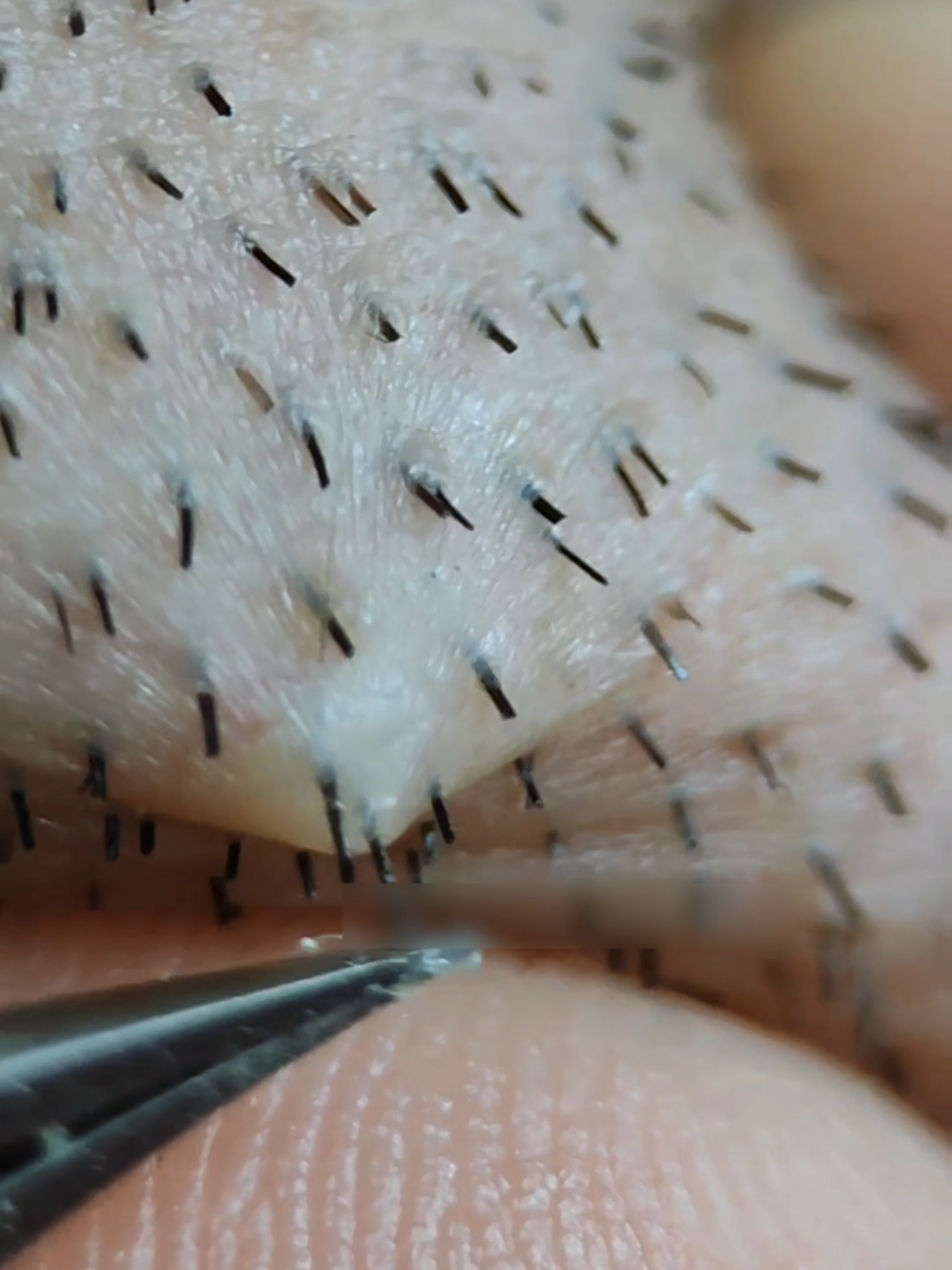 Do you have the same problem? Are you still using this method to remove hair? Stop hurting yourself.#hairy#Confidence#dressforyourself#painless#foryou#careskin #beauty #ipl #hairremoval