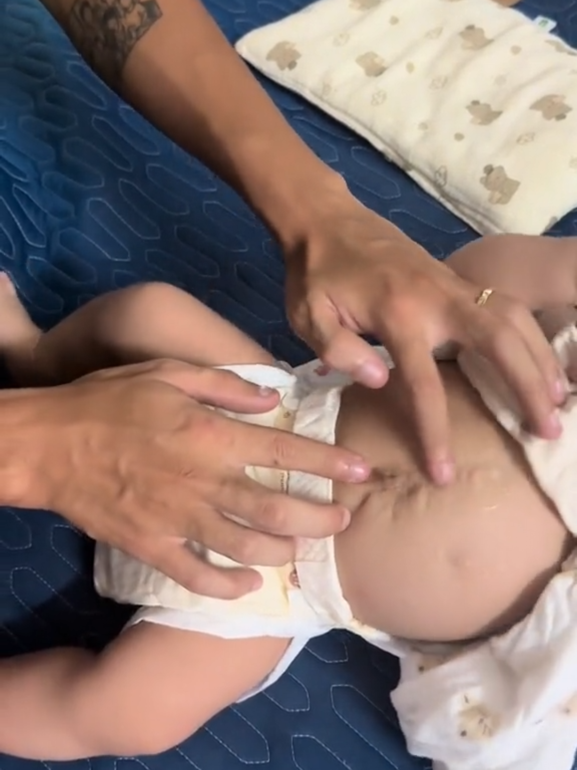 Vết sẹo lớn