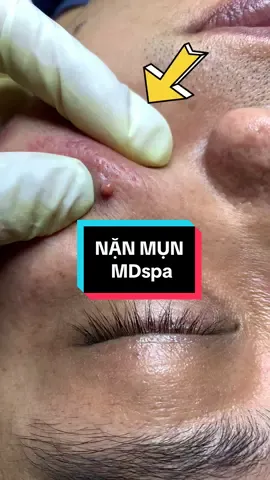 #nặn_mụn #lêthithuydung616 #chuyên_đtri_mụn_rỗ_tpvinh_nghệan #mdspa_chuyên_mụn_rỗ_tpvinh 