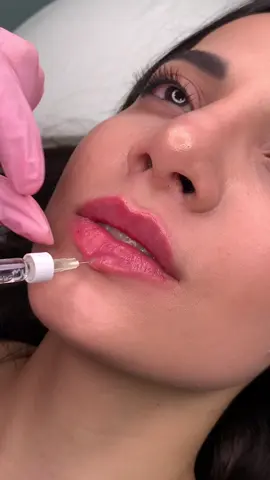 Gördüyünüz kimi bizim dodaqlar şişmir😍💋 #kosmetoloqazerbaycan #kosmetoloqbaku #dodaqdolğusu #kosmetolog #lipsqueen #lipsfiller #dodaq 
