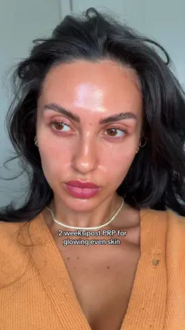 Officially my fav beauty procedure.. I love the PRP glow 🌟 this I would say is WORTH your coin 
