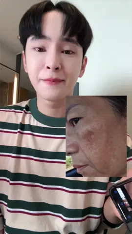 ฝ้าแบบไหนก็จางลงได้ด้วยครีมกิมจิ #ครีมกิมจิ #ครีมกิมจิช่องบริษัท  #ครีมกิมจิรักษาฝ้า #สกินแคร์ #TikTokBeauty #ดูแลตัวเอง