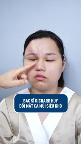 Đối mặt với ca mũi siêu khó #richardhuy #bacsithammy #tuvanthammy #phauthuatthammy #benhvienthammykangnam 