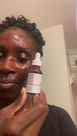 This product has eeally helped with texture of my skin.  Get some FR. #kocofaye #skincare #skin #theordinary #theordinaryskincare #skinpeel #chemicalpeeljourney #chemicalpeel #newskin #newslincare #newskincare 
