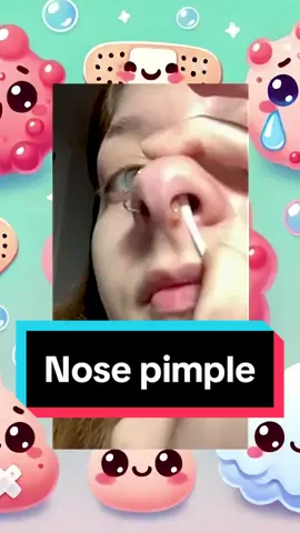 Nose pimple 🤥🤥 #satisfying #pimple #poppers #mbappe 
