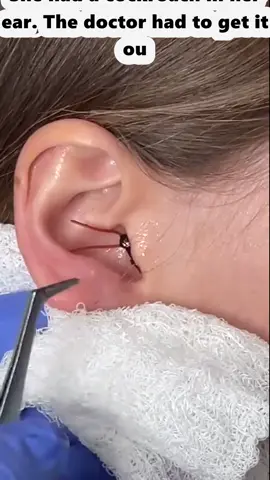 She had a cockroach in her ear. The doctor had to get it ou (3)