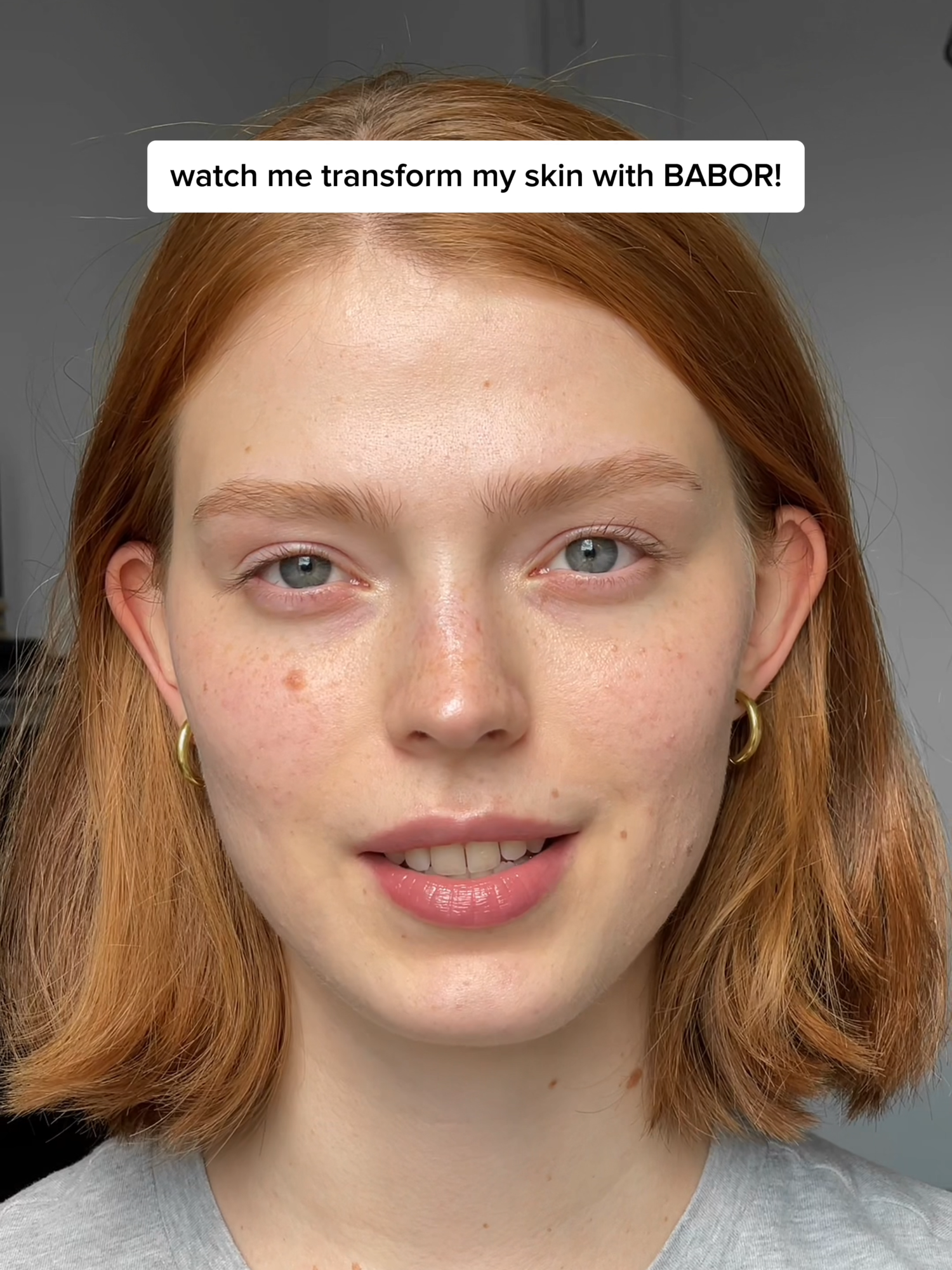 Acne skin transformation! 🧖🏻‍♀️   As part of our 