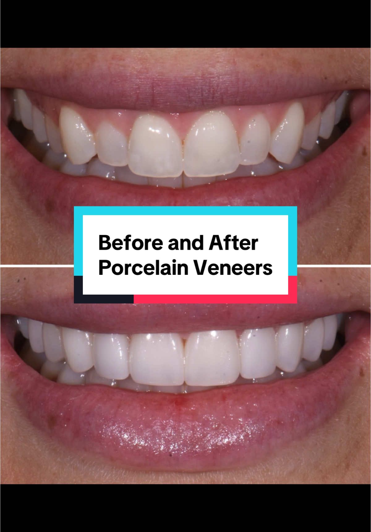 Before and after porcelain Veneers #veneers #veneerbeforeandafter 