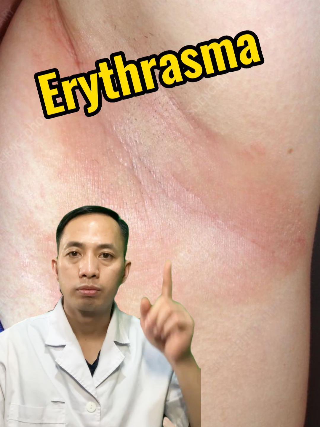 ERYTHRASMA  Tổn thương cơ bản (TTCB) của Erythrasma:Các nếp kẽ có những dát màu nâu hoặc hồng, ranh giới rõ, bong vảy mỏng, bề mặt có những vết nứt nông, ngứa ít hoặc vừa. Các vị trí hay gặp là nách, bẹn, giữa các ngón chân, nếp dưới vú, quanh rốn. #erythrasma #dalieu #benhdalieu #dalieuthammy #xuhuong #nhacxuhuong #xuhuongtiktok