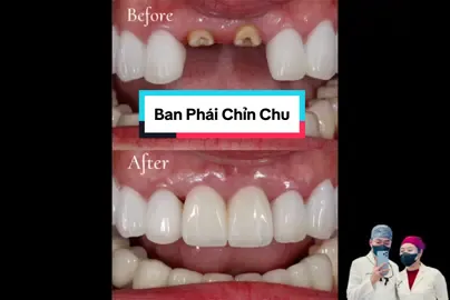 2 tháng đổi lại 1p40s 🤔🤔🤔 #nhasithien #ribbond #verticalprep