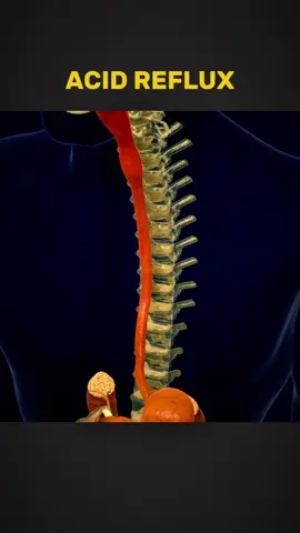 How Acid Reflux Occures? Medical Animation 3D #acidreflux #acidrefluxremedy #esophagusproblems #medicalanimation 