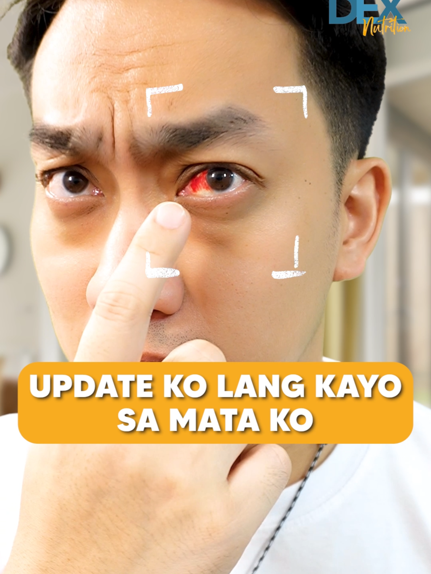 Pumutok na ugat sa Mata Para sa iba pang doctor-approved content, bisitahin ang: https://linktr.ee/drdexmacalintal #fyppage #foryoupagee #learnfromtiktok #BodyAwareness #SubconjunctivalHemorrhage #EyeHealth #PublicHealth #EyeHealthTips