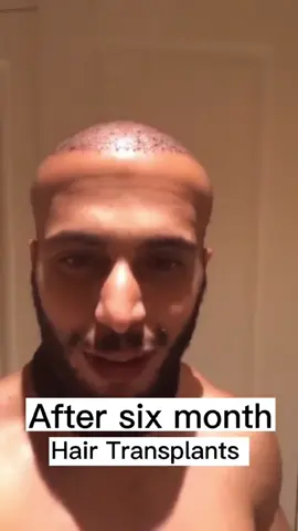 Hair growth from bald doesn’t need operation! #hairtransplant #hairgrowth 