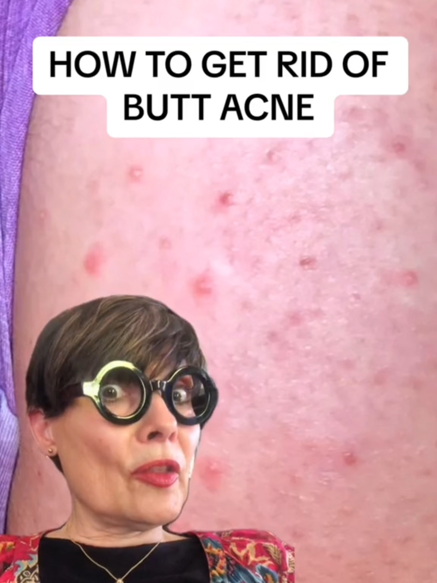 #watchnow on how you can eliminate your stubborn #buttacne! #hygieneroutine