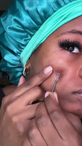 this is gonna be a good one #extractions #satisfying #skintok #acnejourney 