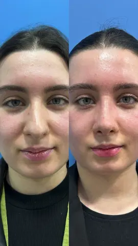 #rhinoplasty #beauty #rinoplastia #nosejob #plasticsurgery #fyp 