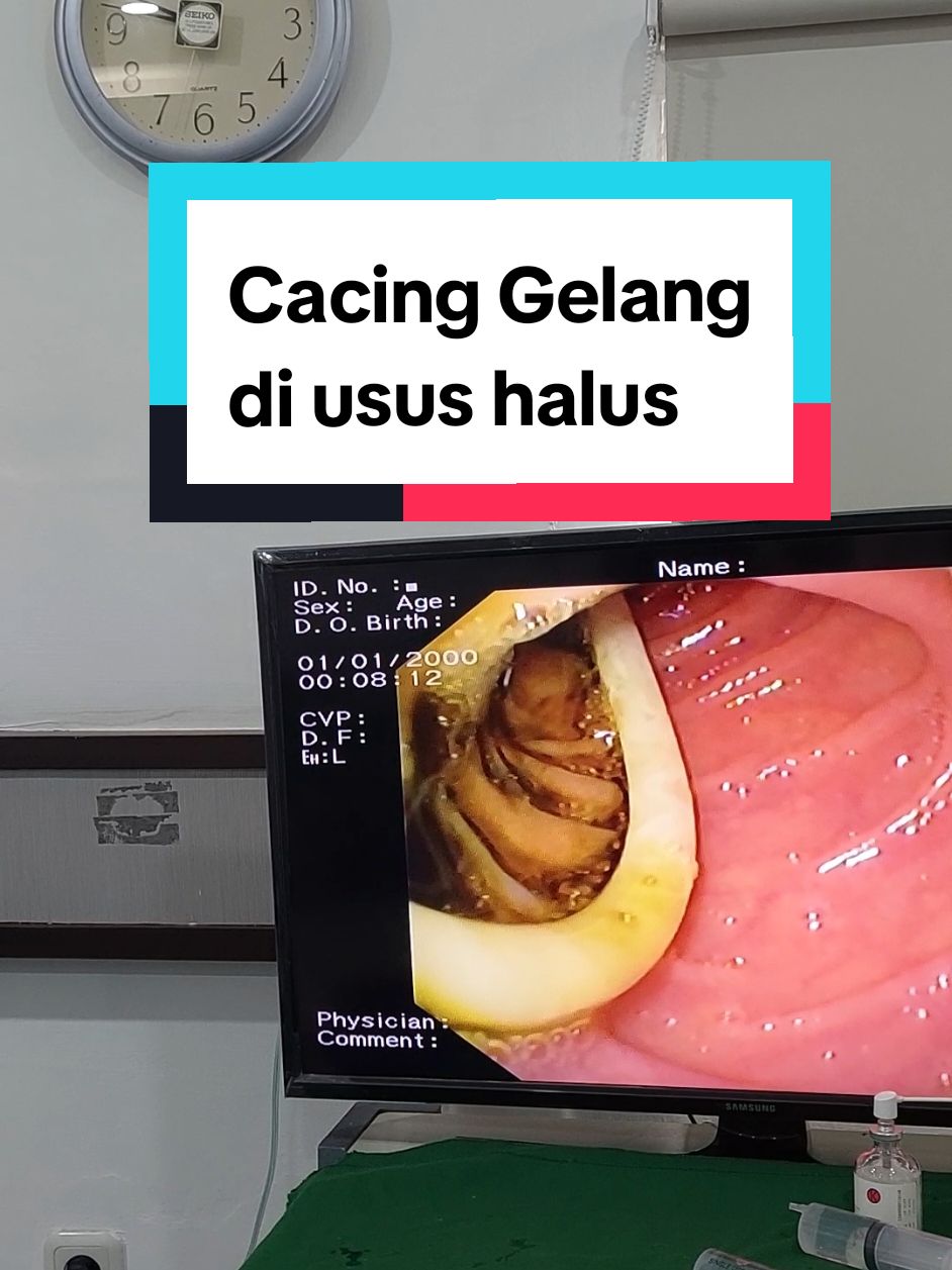 Ascaris lumbricoides adalah cacing gelang parasit besar dari genus Ascaris. Ini adalah cacing parasit yang paling umum pada manusia. Diperkirakan 807 juta–1,2 miliar orang terinfeksi A. lumbricoides di seluruh dunia. Orang yang tinggal di negara tropis dan subtropis mempunyai risiko lebih besar terkena infeksi.  #lambung  #Cacing Gelang Dokter  #usus 