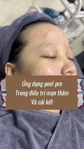 Khách sau 2b peel pro da khác nhiều luôn. Thêm 2 buổi nữa thì đẹp hết nc chấm chị em ạ! #peelpro #peelda #nanmun#peelda #Nặnmụn #nanmunchuanykhoa #dieutridakhoahoc #thainguyen #fyp 