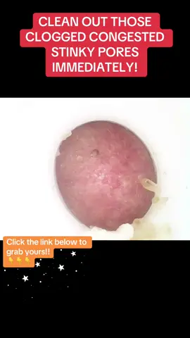 STOP WALKING AROUND WITH DIRTY DISGUSTING PORES AND BLACKHEADS EVERYWHERE!This pore vacuum has been a skincare game changer, my pores have never been so clean!You dont need to hide your pores you just need to clean them!!@Yuleao really outdid themselves with this product, grab it while you still can! #creatorsearchinsights #SelfCare #porecleaning #porevaccum #skincaretips #beautytech #healthyskin #tiktokmademebuyit #porevacuumcam 
