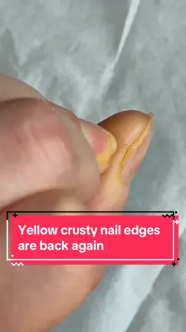 Maybe its temporary?  #fyp#nailtok#manicure#russiannails#flakynails#nailfungaltok 