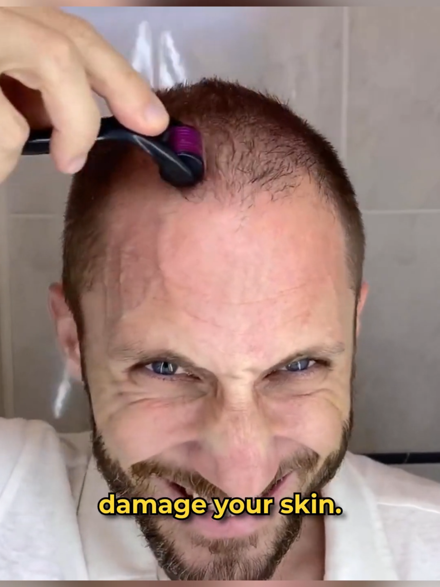 How to use the derma roller for hair loss (3 Easiest Steps)  The brand name is FolliRoll, you can get it on Amazon.com  #dermaroller #dermarolling #minoxidil #hairloss #alopecia #hairresults #algarrido #folliroll #algarrido #microneedling